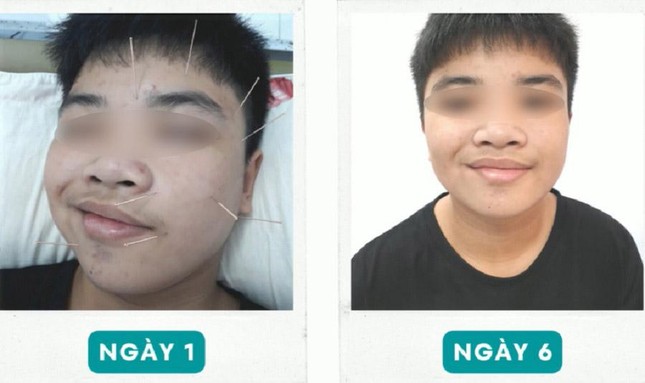 Ngủ dậy, nam sinh tá hỏa vì trúng "khẩu nhãn oa tà"