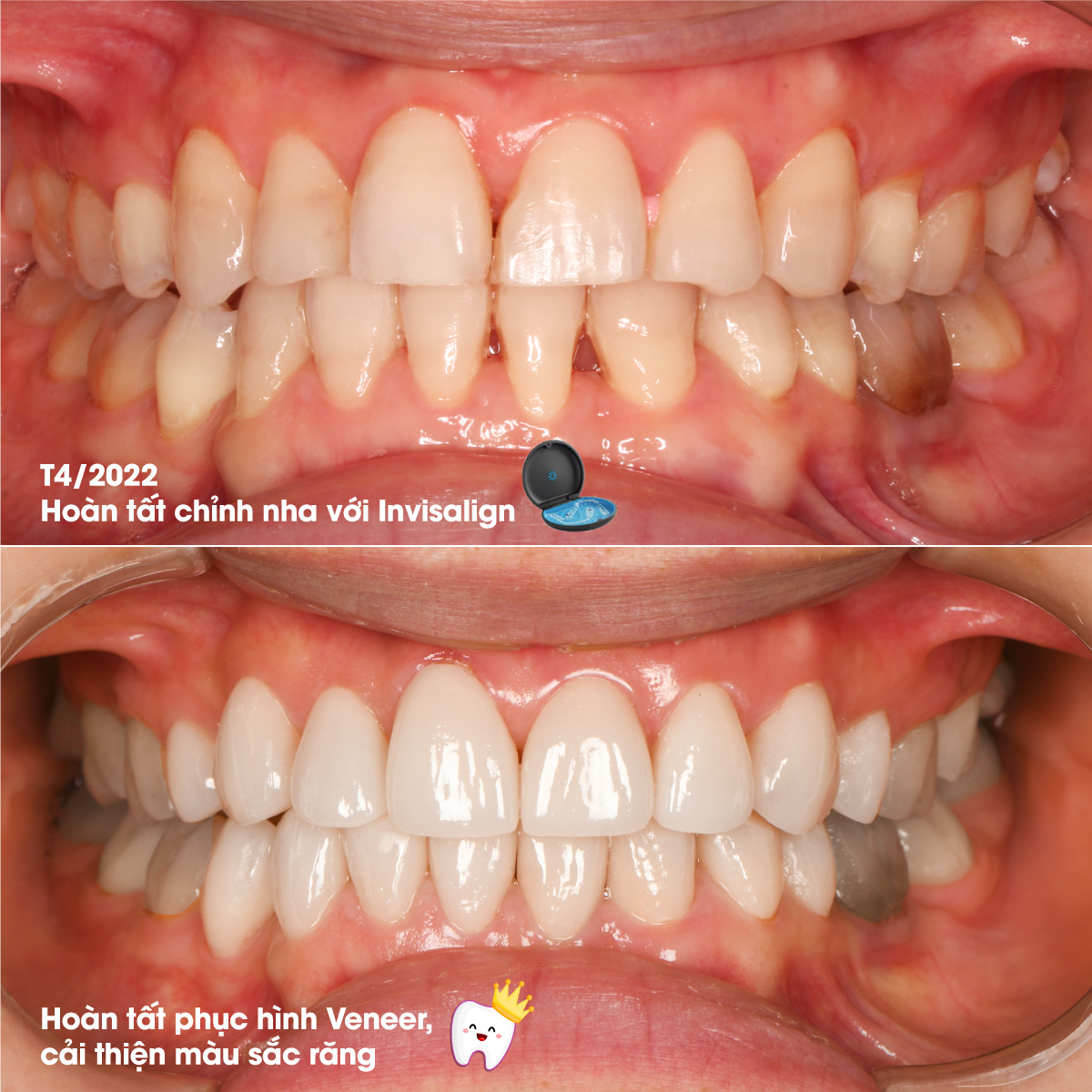 Cách để có hàm răng đẹp bền lâu - Ảnh 1.