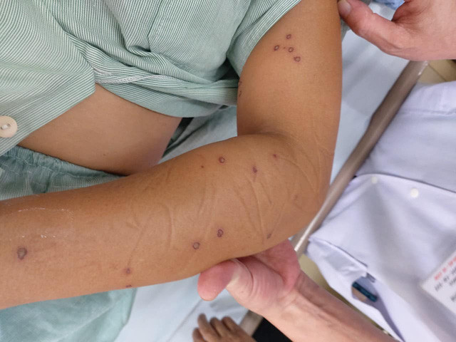 Người phụ nữ trẻ nguy kịch v&igrave; bị 70 nốt ong v&ograve; vẽ đốt - Ảnh 1.