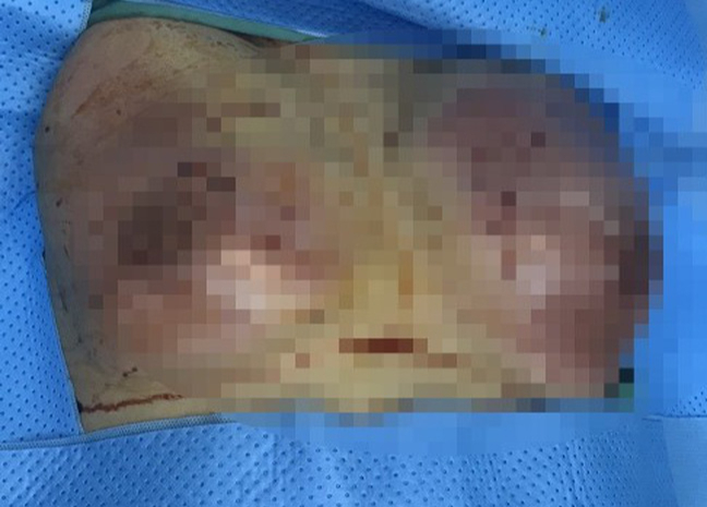 Tiêm filler nâng ngực, người phụ nữ bị hoại tử "núi đôi", sắp vỡ