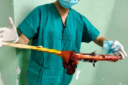 Ớn lạnh người đàn ông bị cây gỗ đâm xuyên từ trước ngực ra sau lưng