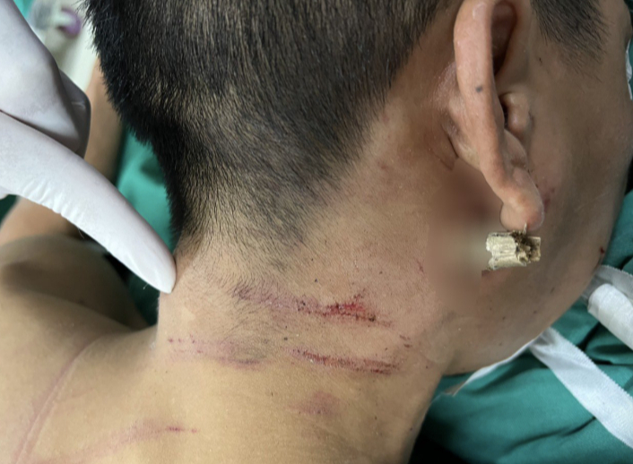 Ngã xe máy, nam thanh niên bị thanh tre đâm xuyên cổ