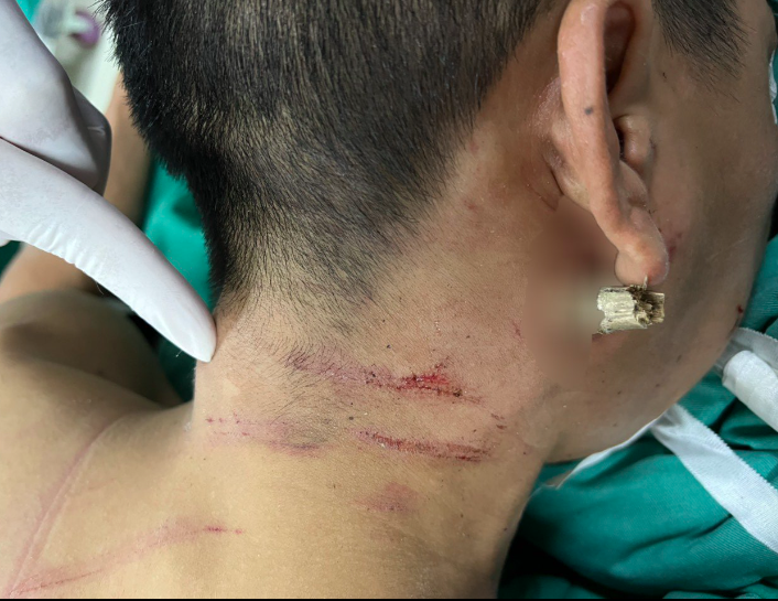 Ng&atilde; xe m&aacute;y, nam thanh ni&ecirc;n bị thanh tre đ&acirc;m xuy&ecirc;n cổ  - Ảnh 1.