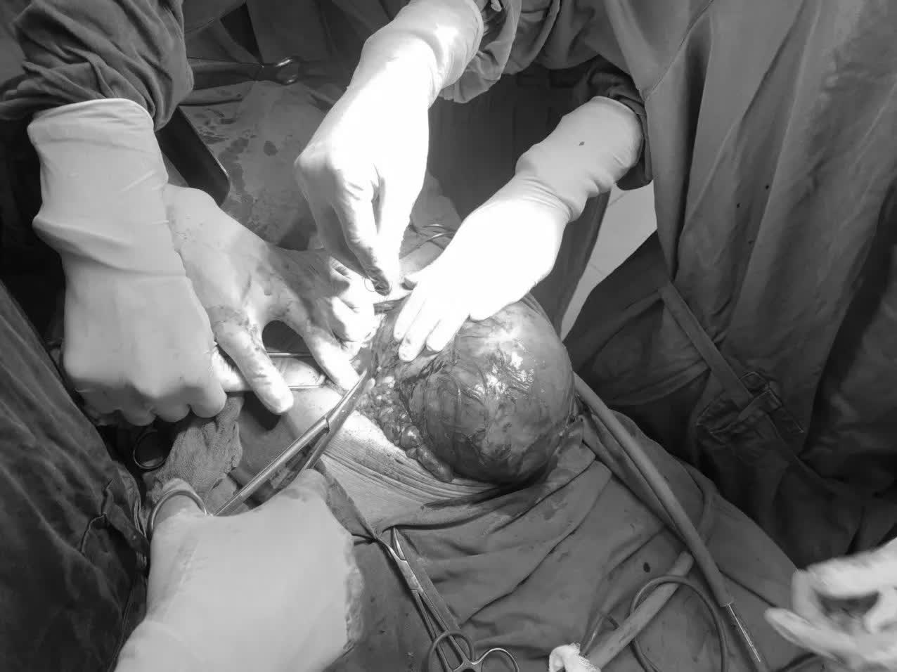 Tưởng b&eacute;o bụng do uống bia h&oacute;a ra khối u khổng lồ - Ảnh 1.