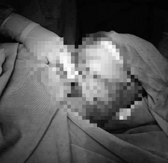 Ngã dàn giáo, nam thanh niên bị thanh sắt đâm xuyên cổ