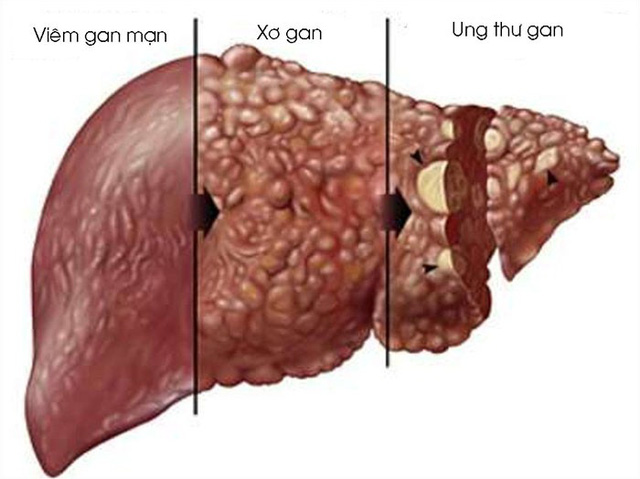 Bác sĩ  đưa "bí kíp" bảo vệ lá gan ngày Tết