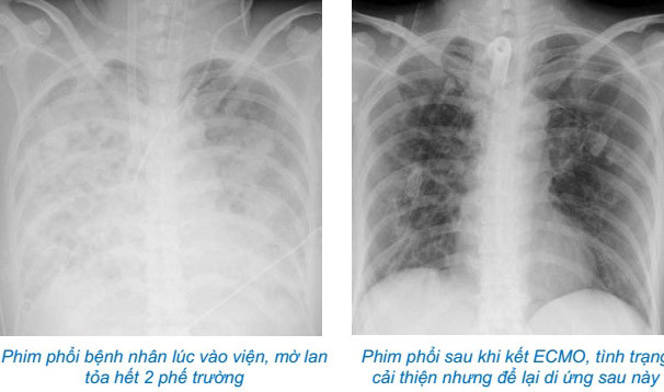 Lạm dụng corticoid tự điều trị c&uacute;m, nữ bệnh nh&acirc;n 37 tuổi suy đa tạng - Ảnh 1.