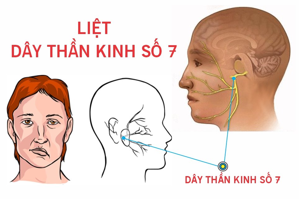 Làm sao chữa di chứng liệt dây thần kinh số 7 sau khi bị zona?
