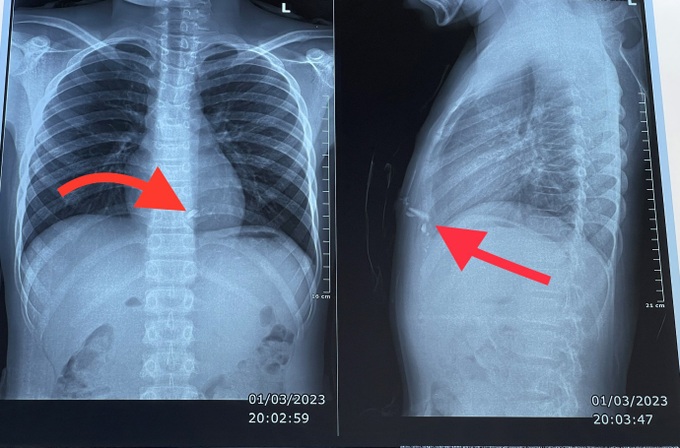 Ph&aacute;o tự chế ph&aacute;t nổ khiến thiếu ni&ecirc;n 14 tuổi bỏng mặt, 2 tay v&agrave; ch&acirc;n, nghi tổn thương tim - Ảnh 1.