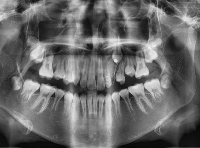 Thiếu niên 16 tuổi đột ngột sưng lợi, hoá ra u máu ác tính