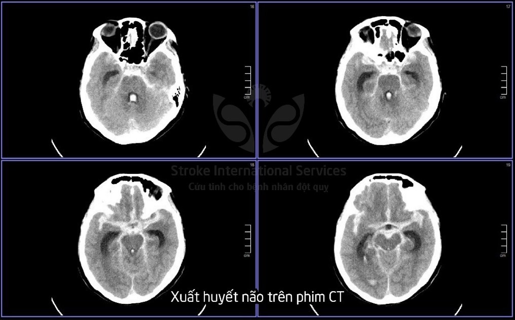 Ca bệnh 90% tử vong, bác sĩ nói "còn nước còn tát"