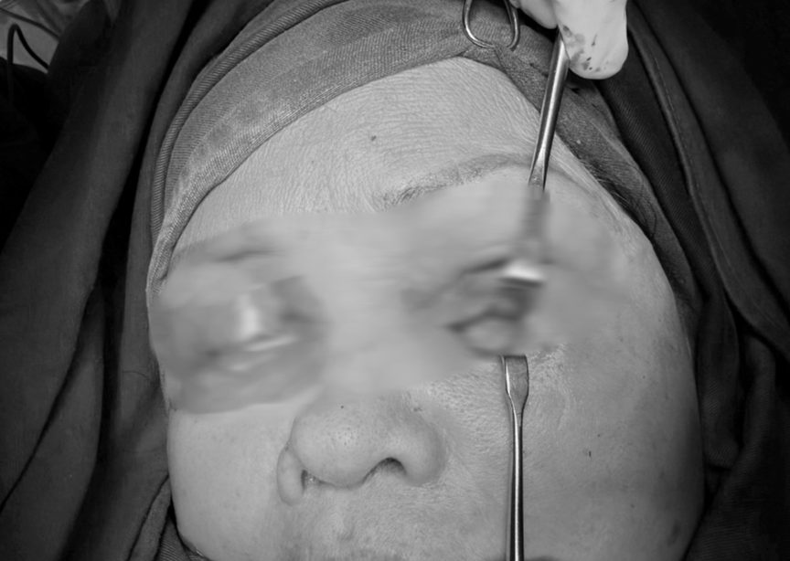 Ti&ecirc;m filler trị th&acirc;m, nữ kh&aacute;ch h&agrave;ng bị ti&ecirc;m &ocirc;xy gi&agrave; v&agrave;o mắt - Ảnh 1.