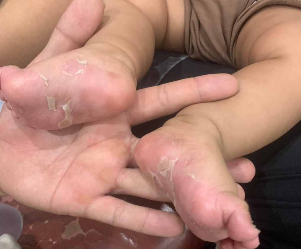 Bé trai 3 tháng tuổi mắc bệnh giang mai bẩm sinh - Ảnh 3.