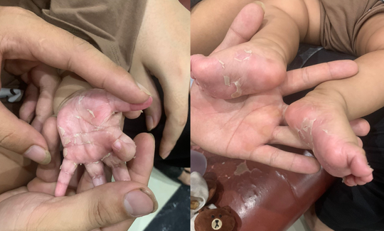 Bé trai 3 tháng tuổi mắc bệnh giang mai bẩm sinh - Ảnh 1.