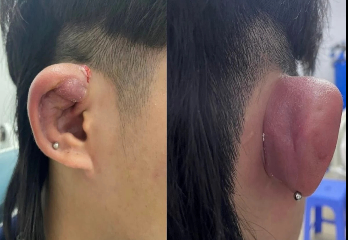 Nhiễm trùng, hoại tử sụn do bấm nhiều lỗ tai