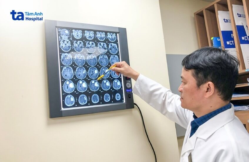 Cứu người phụ nữ bị c&ugrave;ng l&uacute;c 2 khối u n&atilde;o  - Ảnh 1.