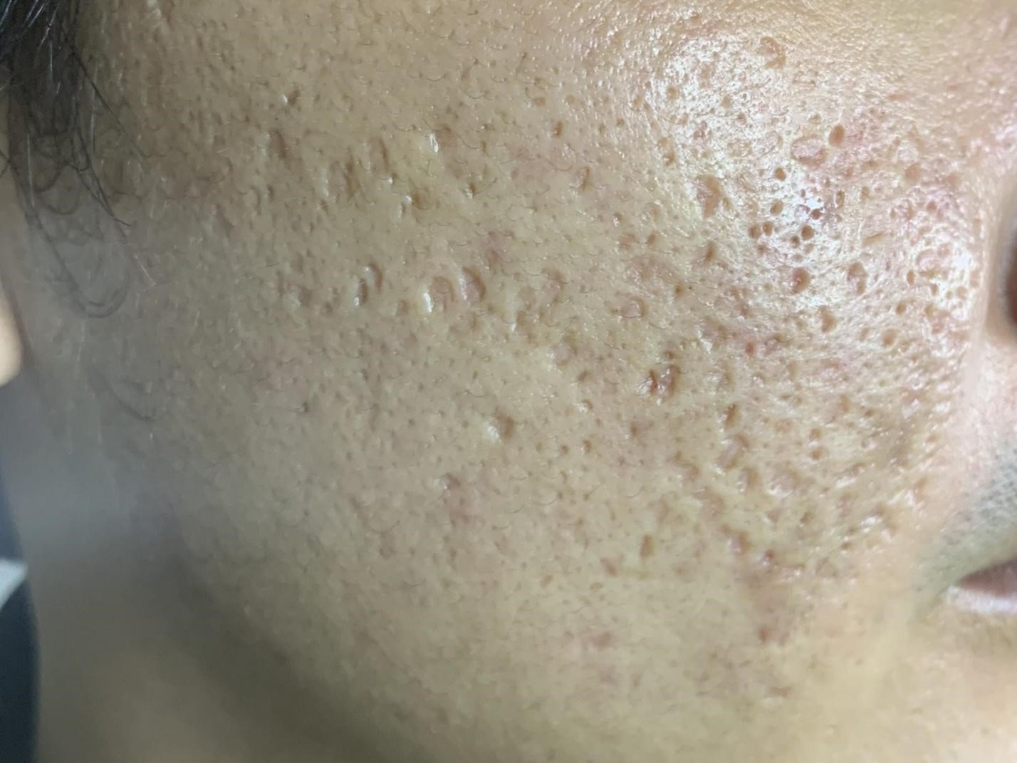 Vì sao chỉ nên điều trị sẹo rỗ với bác sĩ da liễu? - Ảnh 1.
