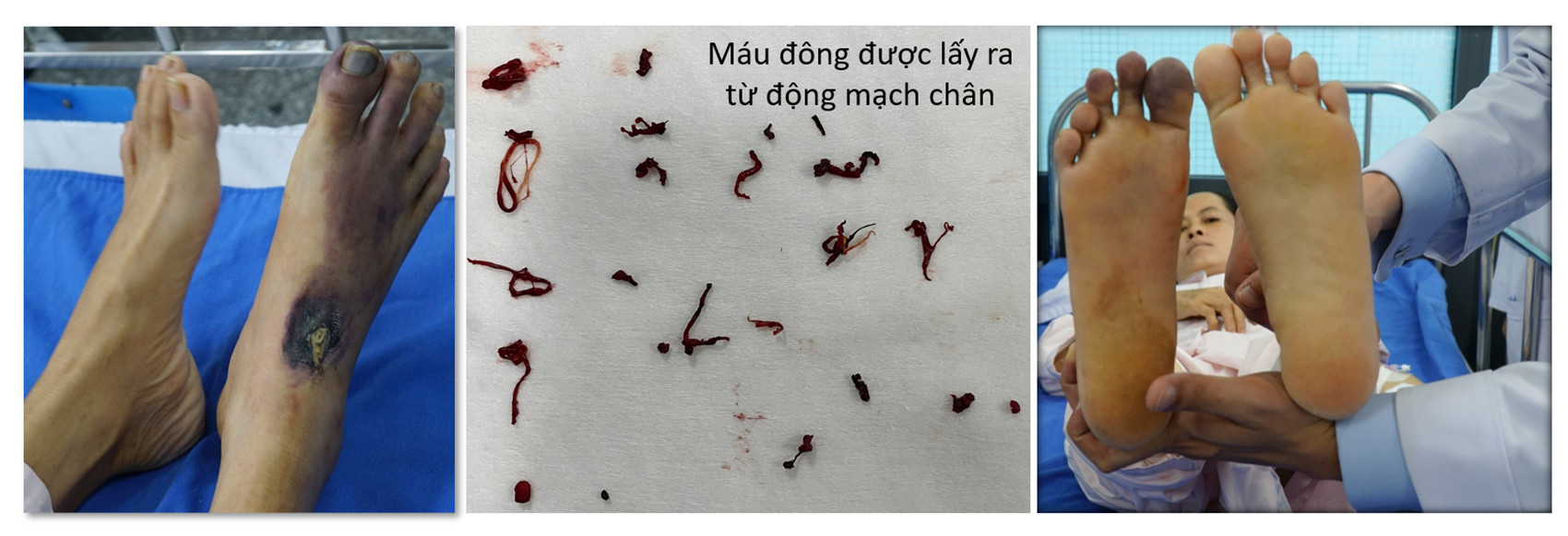 Cứu được ca bệnh hiểm nghèo sắp đưa về quê buông xuôi theo số phận