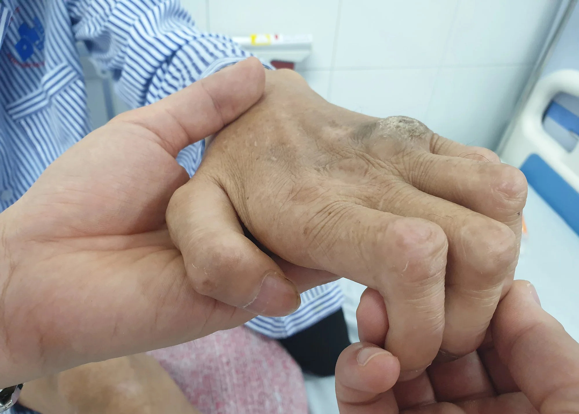 Phát hiện nhiều người mắc bệnh phong tại các thành phố lớn