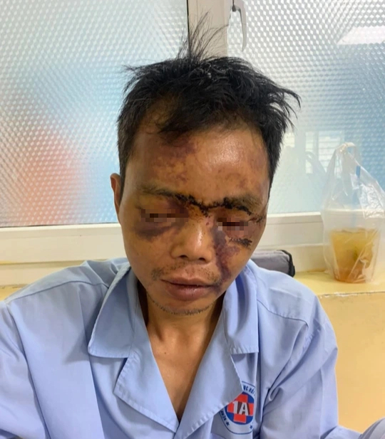 Công nhân bị tai nạn, công ty không khai báo