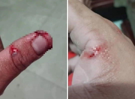 Người đàn ông tử vong sau hơn 1 tháng bị chó cắn