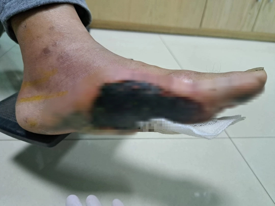 Bệnh nh&acirc;n đ&aacute;i th&aacute;o đường lo&eacute;t b&agrave;n ch&acirc;n do th&oacute;i quen thường gặp - Ảnh 3.