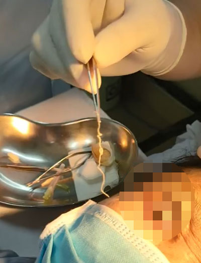 Phát hiện con giun dài 10cm trong mắt người phụ nữ