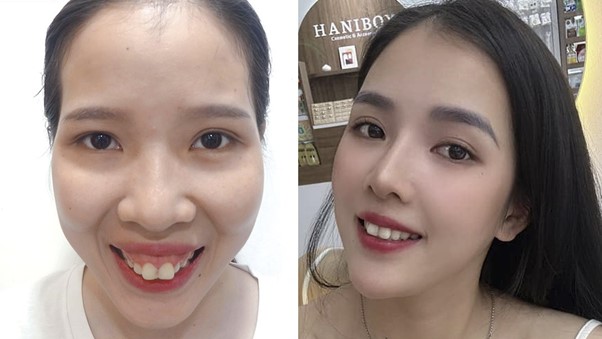 Phẫu thuật thẩm mỹ theo &ldquo;bản sao&rdquo; người nổi tiếng  hay &ldquo;bản sắc ri&ecirc;ng&rdquo;?- Ảnh 2.