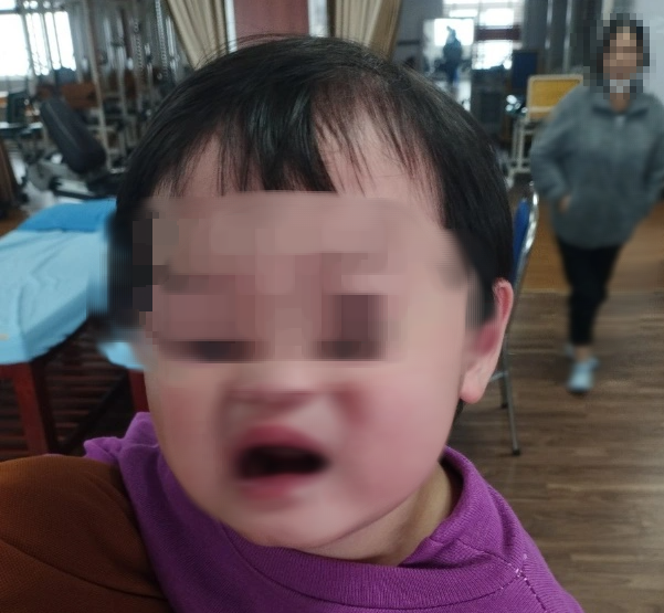 B&eacute; 2 tuổi m&eacute;o miệng, liệt d&acirc;y thần kinh số 7 do trời lạnh- Ảnh 1.