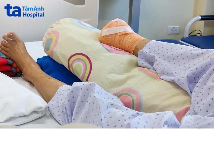 Người phụ nữ mất ch&acirc;n v&igrave; tự ch&iacute;ch kim nặn mủ- Ảnh 1.