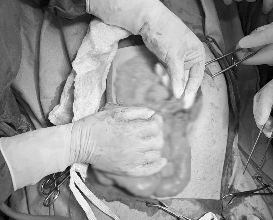 Người đ&agrave;n &ocirc;ng sốc mất m&aacute;u do dao đ&acirc;m thấu bụng, lộ tạng- Ảnh 1.