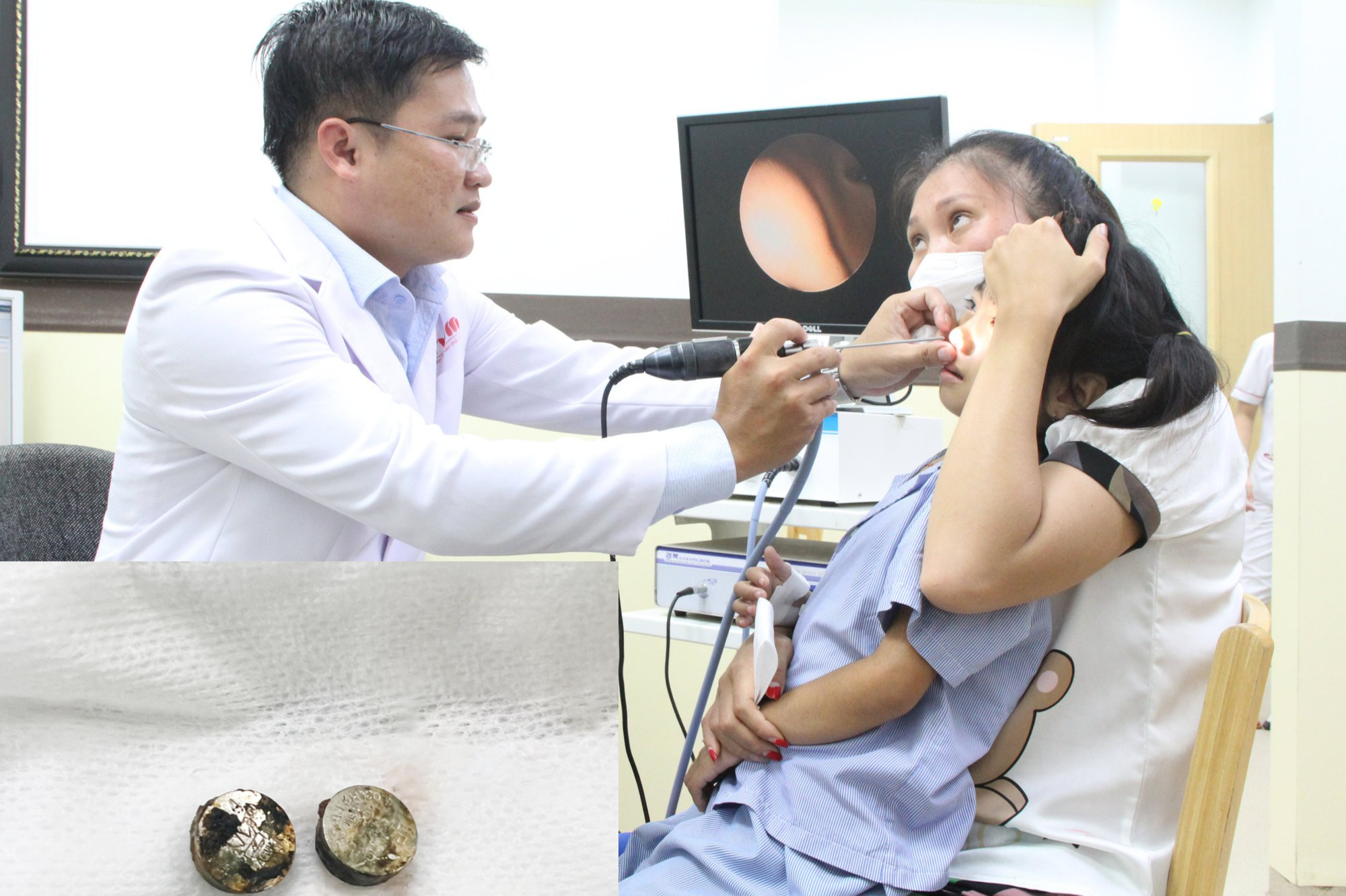 CLIP: Lấy ra 2 viên pin nằm sâu trong khoang mũi bé gái