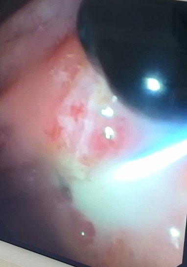 Lôi được cục sỏi kẹt trong người phụ nữ