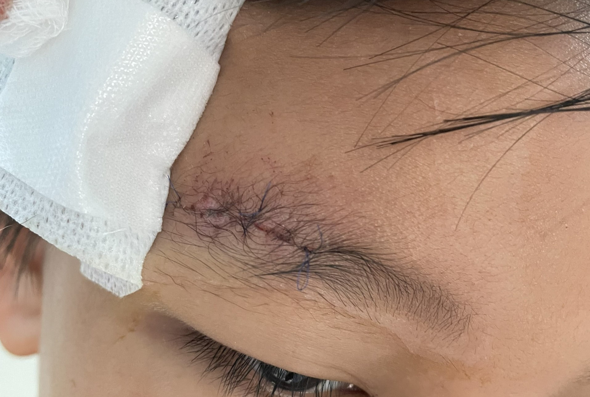 Bé trai suýt mù do viên đạn găm vào hốc mắt