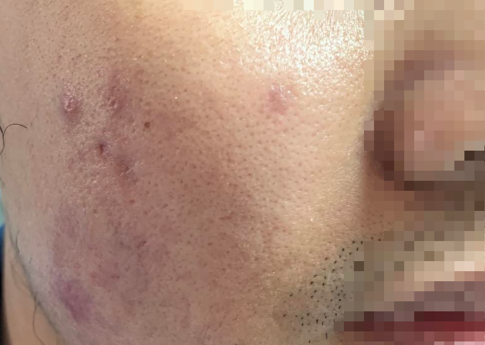 Tiêm chất làm đẹp da, nam thanh niên bị biến chứng vùng mặt