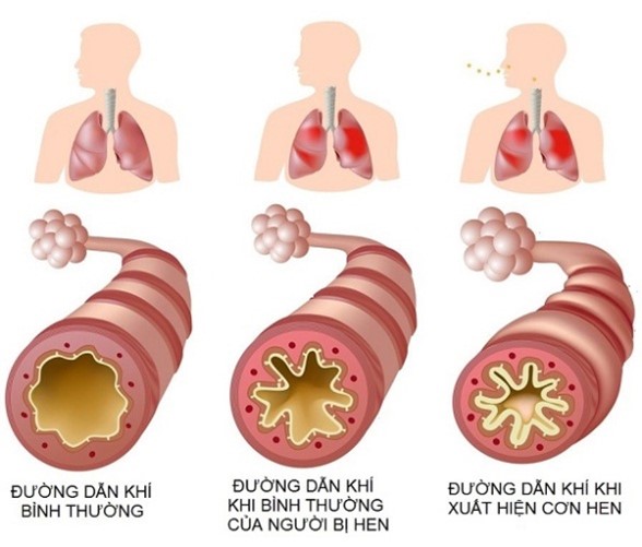 Nguy&ecirc;n nh&acirc;n, chẩn đo&aacute;n v&agrave; ph&ograve;ng ngừa c&aacute;c bệnh l&yacute; h&ocirc; hấp - Ảnh 1.