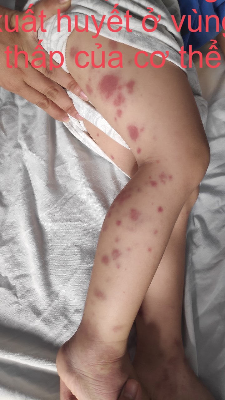 Bé trai lộ bệnh như bị "bạo hành" khiến cha mẹ một phen sợ hãi