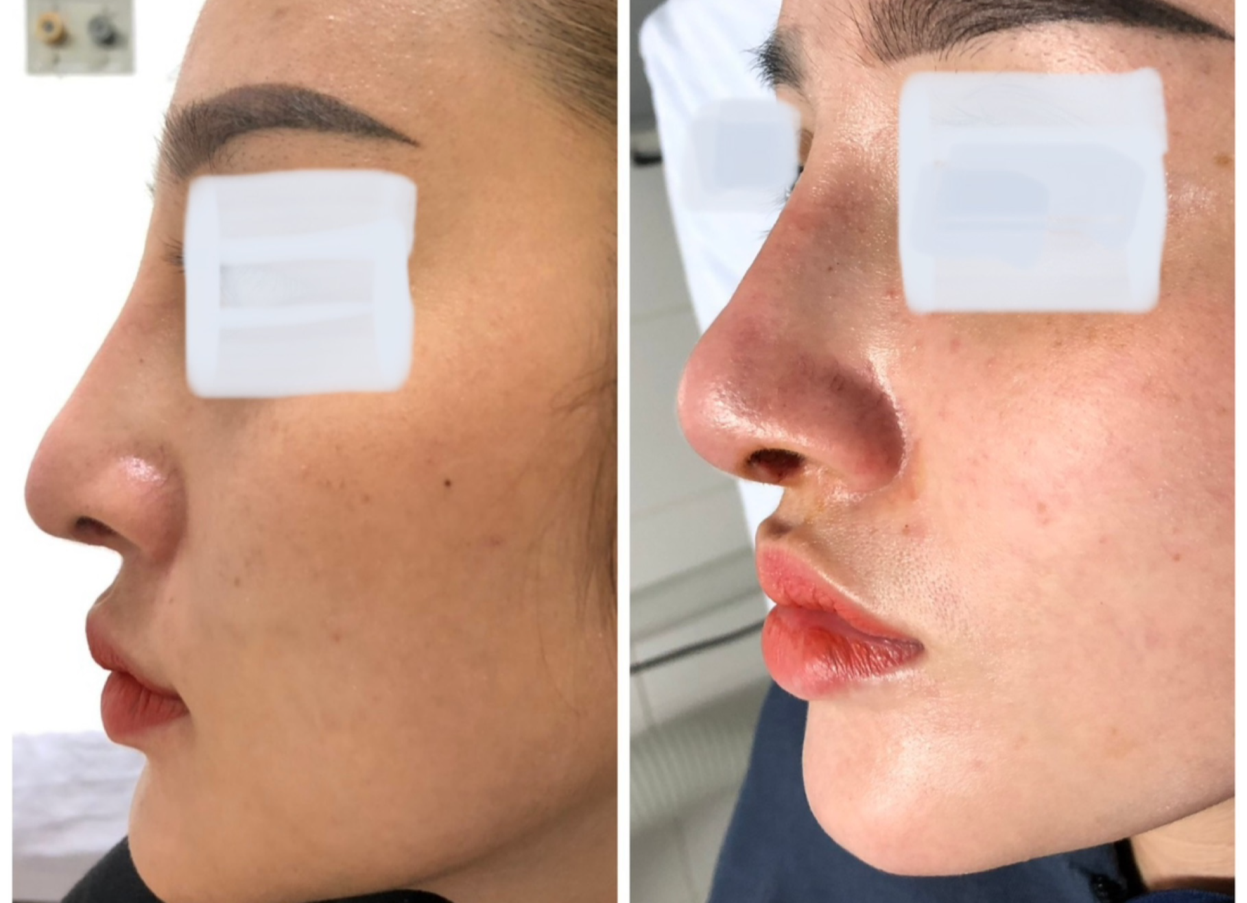 Cô gái ở Vĩnh Long gặp nạn sau khi nâng mũi