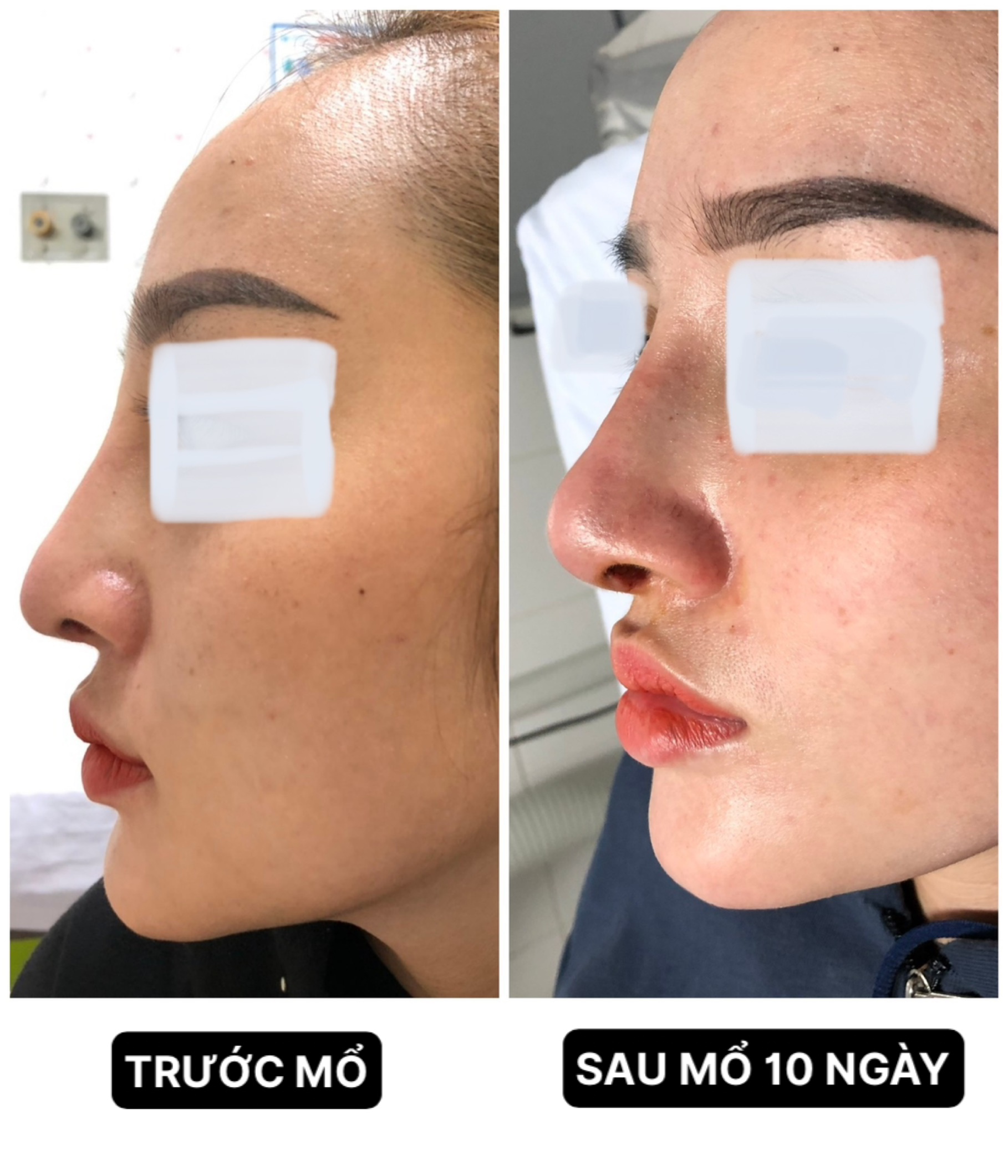 Cô gái ở Vĩnh Long gặp nạn sau khi nâng mũi - Ảnh 1.