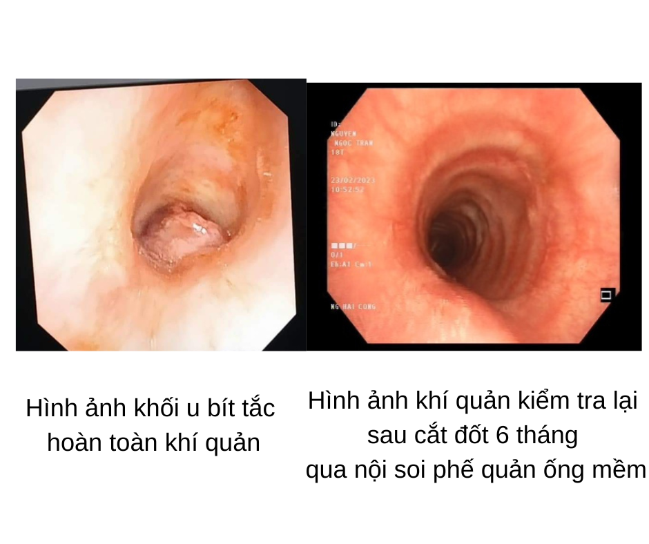 Bệnh hay gặp ở màng nhầy đường sinh dục nhưng lại xuất hiện ở khí quản cô gái 17 tuổi