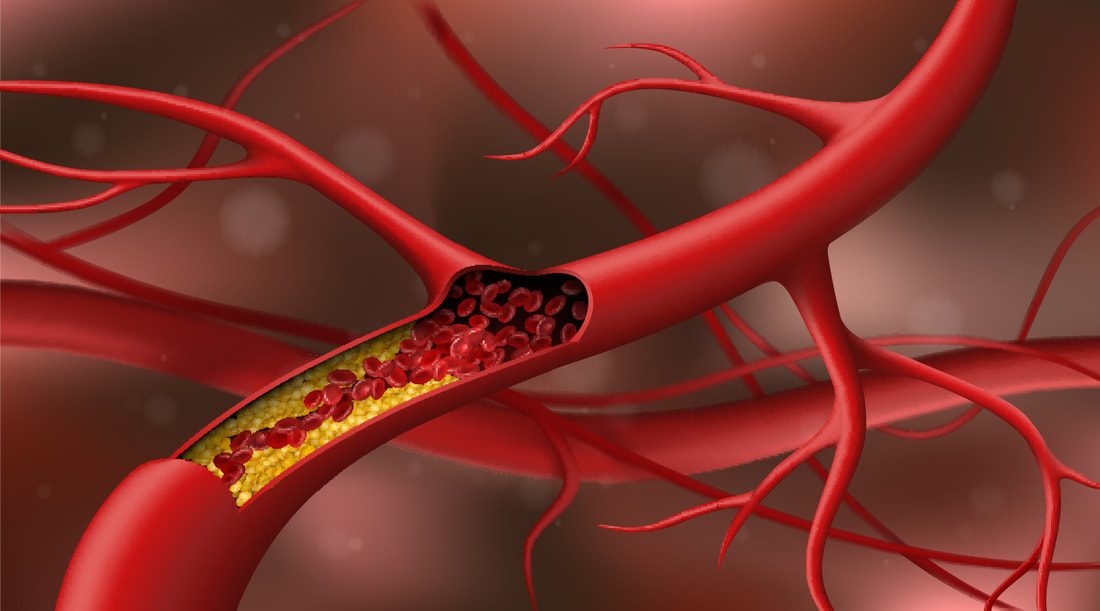 Cholesterol cao: Thêm nguyên nhân bất ngờ, không liên quan ăn uống