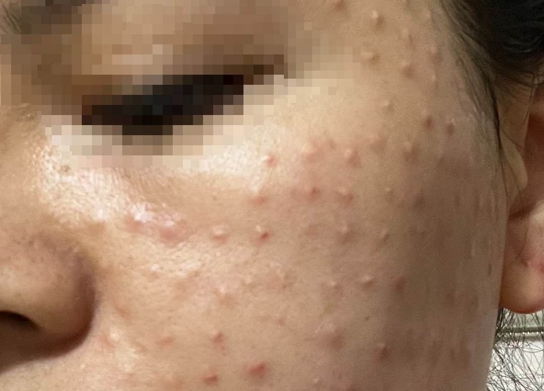 Mặt chi chít u hạt sau buổi tiêm làm đẹp da miễn phí