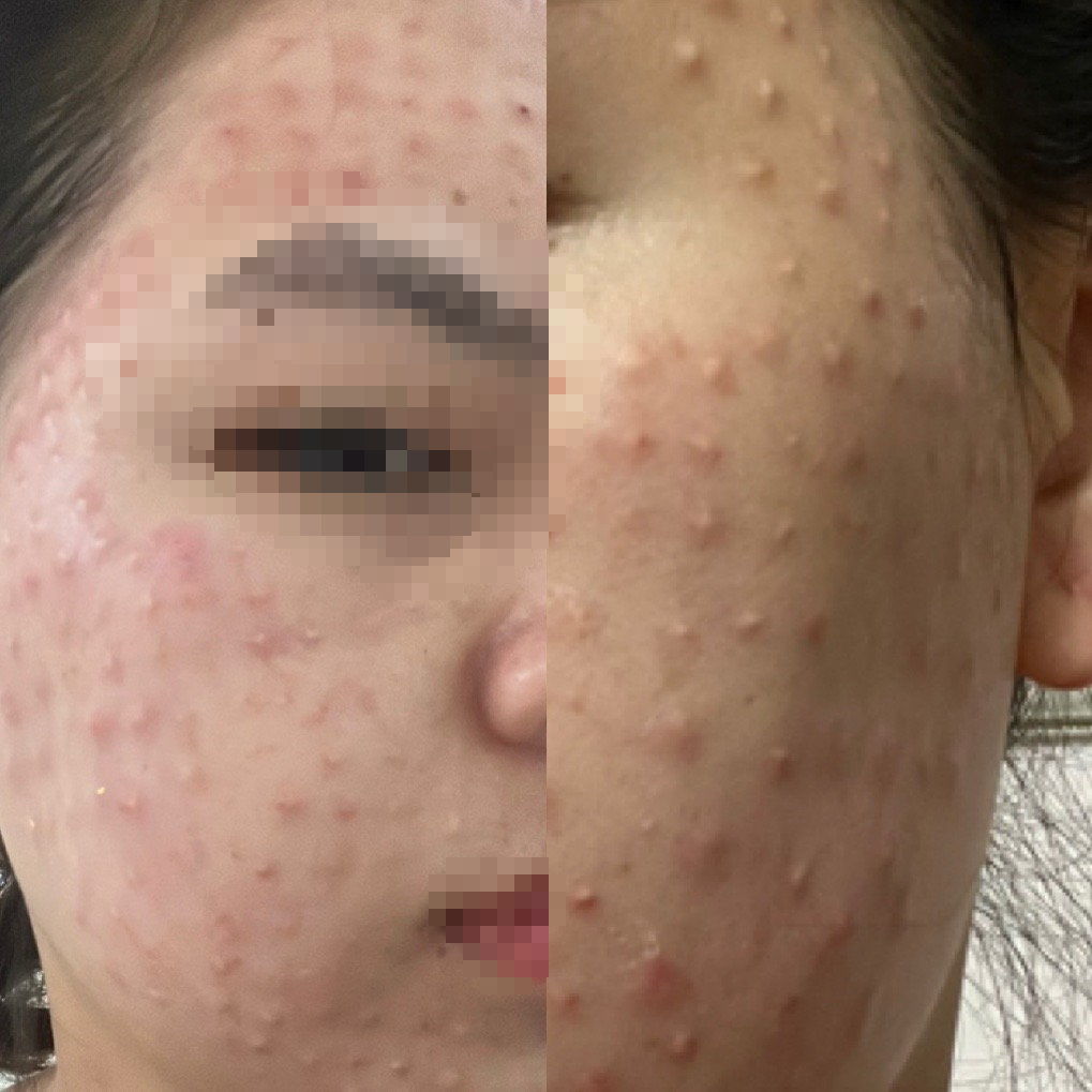 Mặt chi ch&iacute;t u hạt sau buổi ti&ecirc;m l&agrave;m đẹp da miễn ph&iacute; - Ảnh 1.