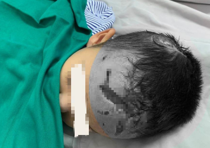 Ch&oacute; nh&agrave; mới đẻ cắn b&eacute; trai 23 th&aacute;ng tuổi  - Ảnh 1.