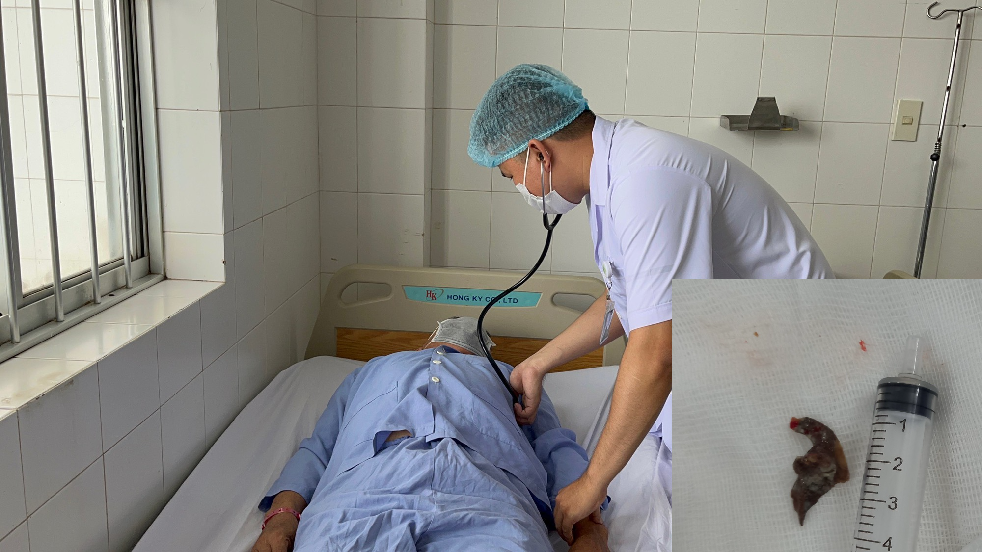 Người đàn ông gặp nạn vì xương cá lọt vào phổi
