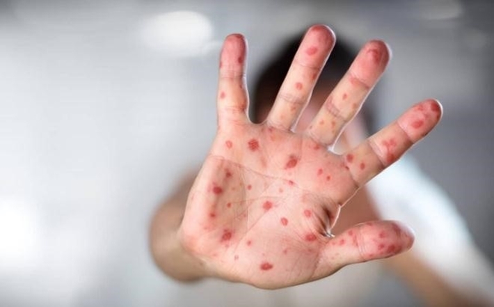 Trẻ đã mắc tay chân miệng có bị tái nhiễm?