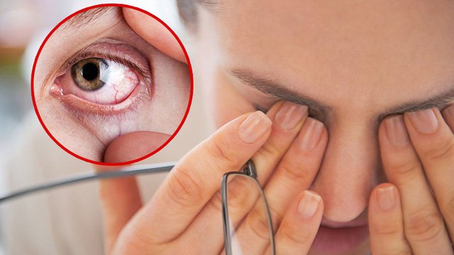 4 c&aacute;ch cải thi&ecirc;̣n mắt kh&ocirc; và m&ecirc;̣t mỏi - Ảnh 1.
