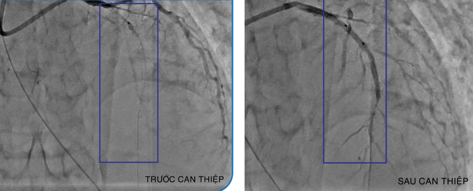 Cứu bệnh nhân Campuchia nhồi máu cơ tim từ cửa tử - Ảnh 2.