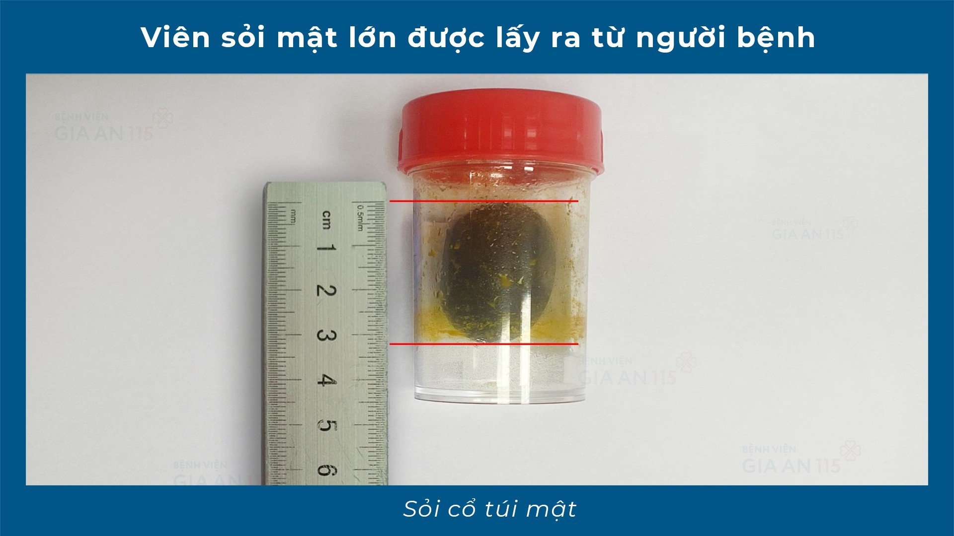 Nguy kịch vì sỏi mật "lặn" sâu