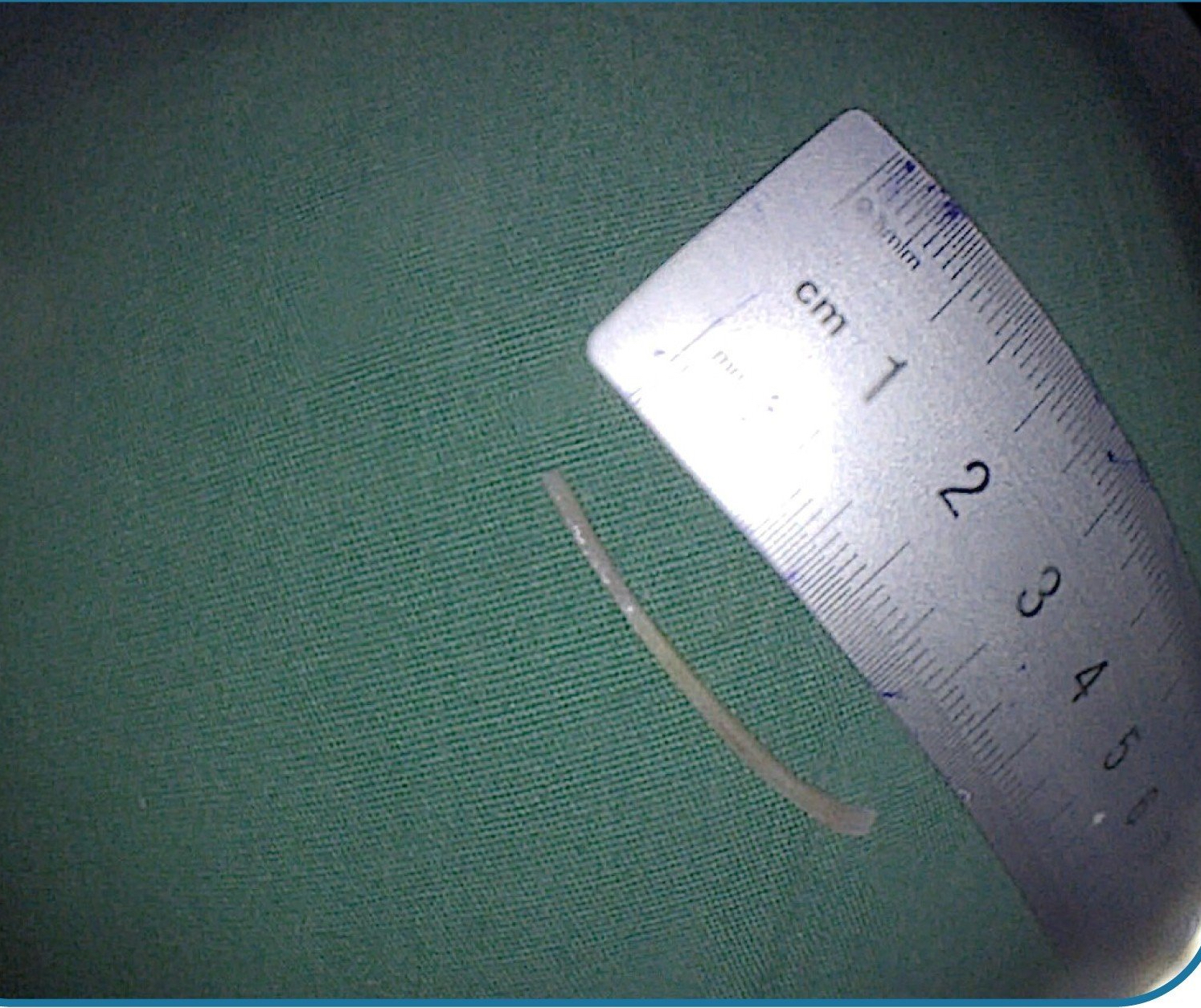 Đau bụng đi cấp cứu, ph&aacute;t hiện xương c&aacute; 3,5cm đ&acirc;m thủng ruột - Ảnh 2.